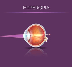 LASIK For Hyperopia What is Hyperopia and what causes it - LASIK For Farsightedness