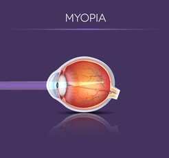 Myopia diagram