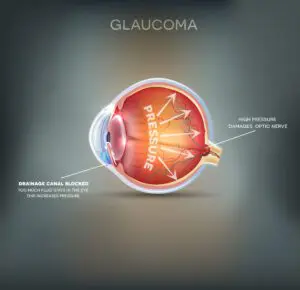 glaucoma diagram