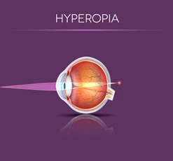 Example of Hyperopia