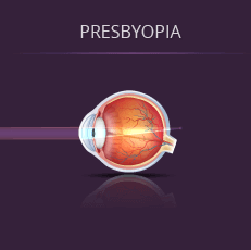 Example of Presbyopia