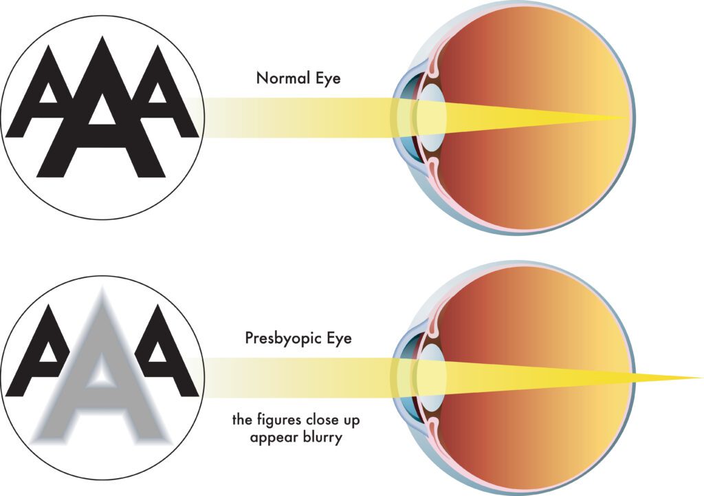 What Is Presbyopia