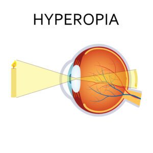 Hyperopia Diagram