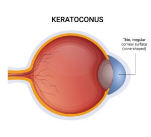 keratoconus diagram