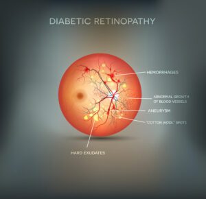 diabetic retinopathy